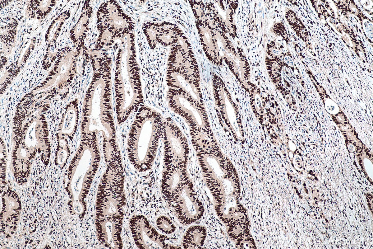 Immunohistochemical analysis of paraffin-embedded human colon cancer tissue slide using KHC0172 (NSUN2 IHC Kit).