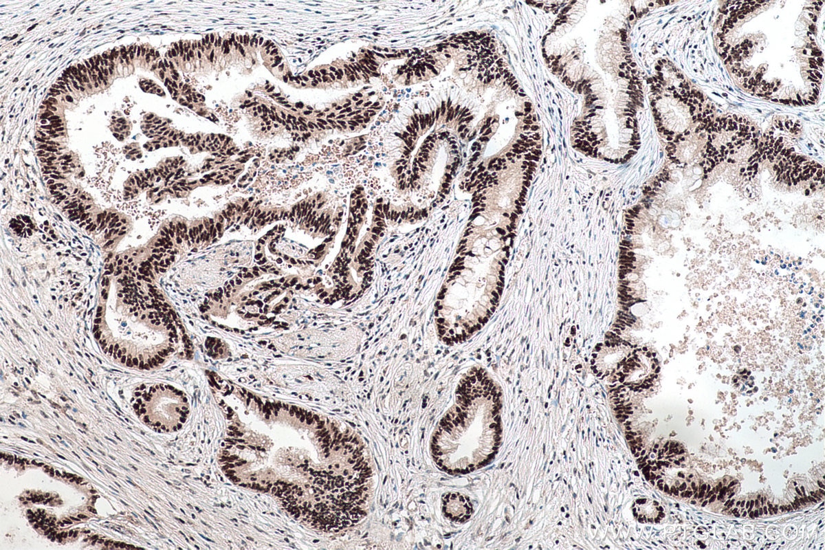 Immunohistochemical analysis of paraffin-embedded human pancreas cancer tissue slide using KHC0172 (NSUN2 IHC Kit).