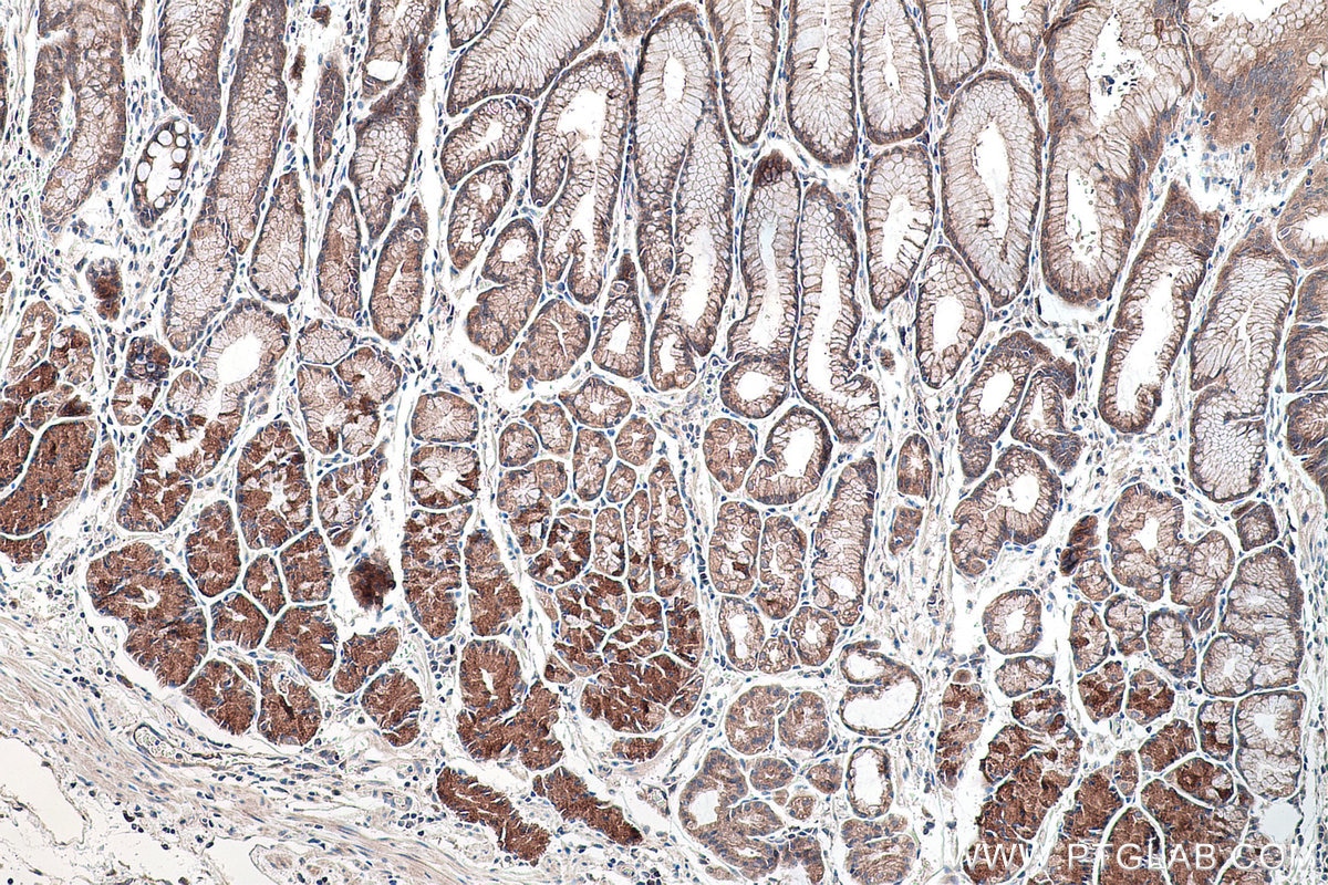 Immunohistochemical analysis of paraffin-embedded human stomach cancer tissue slide using KHC0173 (NSUN6 IHC Kit).