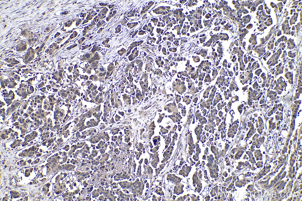 Immunohistochemical analysis of paraffin-embedded human colon cancer tissue slide using KHC0968 (NT5DC1 IHC Kit).