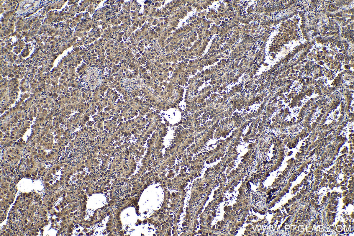 Immunohistochemical analysis of paraffin-embedded human lung cancer tissue slide using KHC0968 (NT5DC1 IHC Kit).