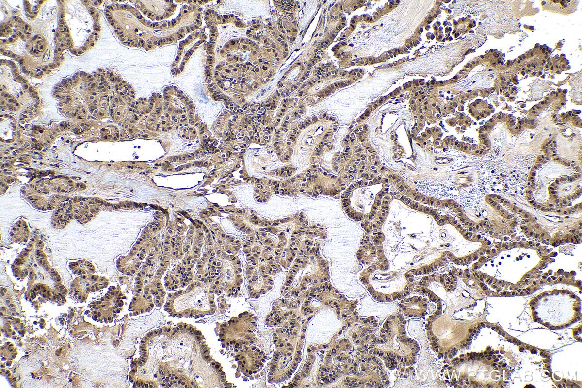 Immunohistochemical analysis of paraffin-embedded human thyroid cancer tissue slide using KHC0968 (NT5DC1 IHC Kit).