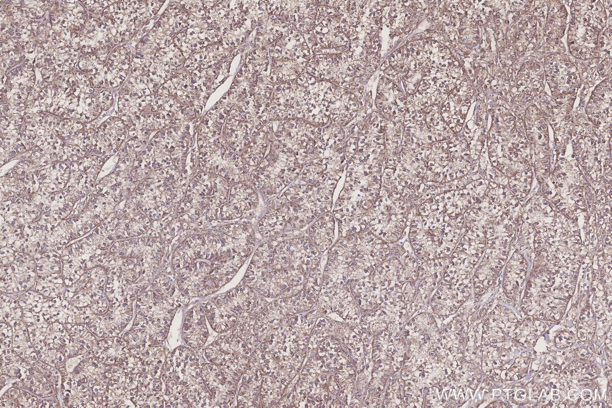 Immunohistochemical analysis of paraffin-embedded human renal cell carcinoma tissue slide using KHC3226 (NUBP1 IHC Kit).