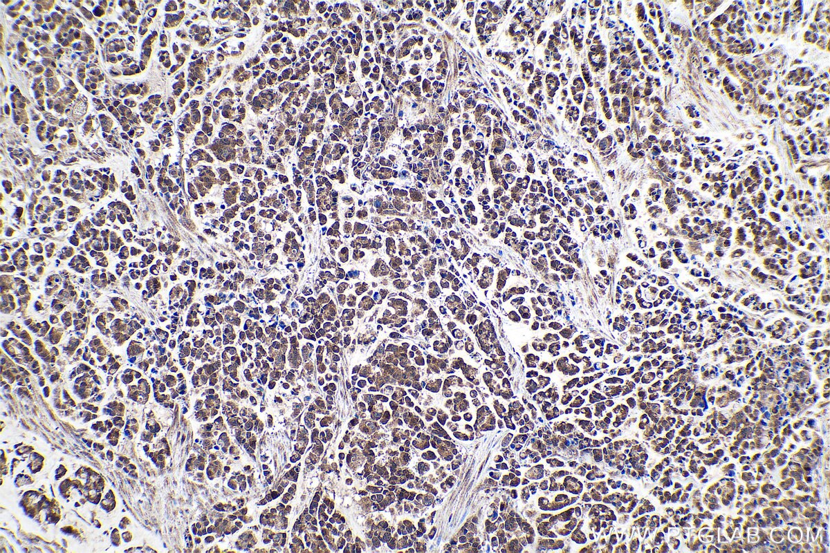 Immunohistochemical analysis of paraffin-embedded human colon cancer tissue slide using KHC0946 (NUDT1/MTH1 IHC Kit).
