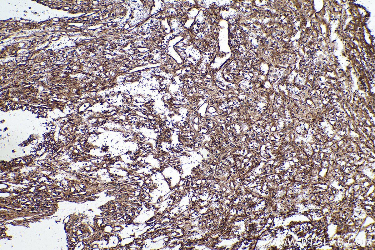 Immunohistochemical analysis of paraffin-embedded human renal cell carcinoma tissue slide using KHC0946 (NUDT1/MTH1 IHC Kit).