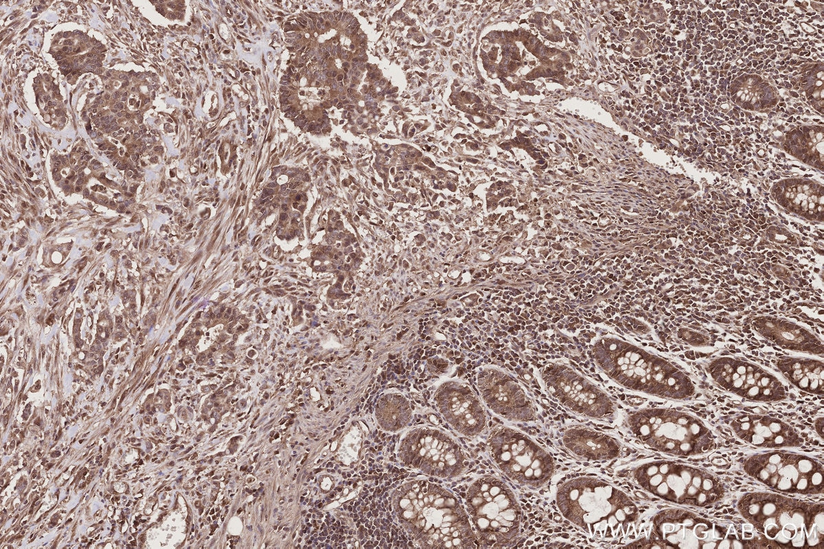 Immunohistochemical analysis of paraffin-embedded human rectal cancer tissue slide using KHC2786 (NUDT16 IHC Kit).