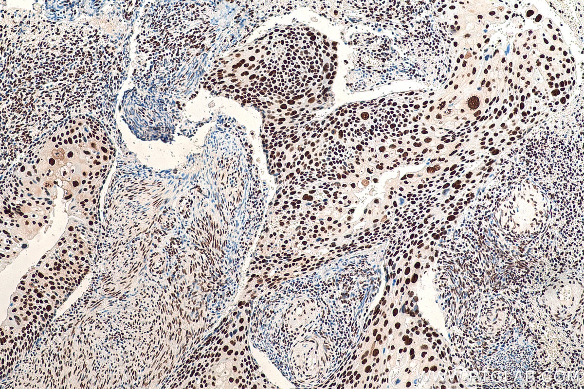 Immunohistochemical analysis of paraffin-embedded human cervical cancer tissue slide using KHC0870 (NUDT21 IHC Kit).