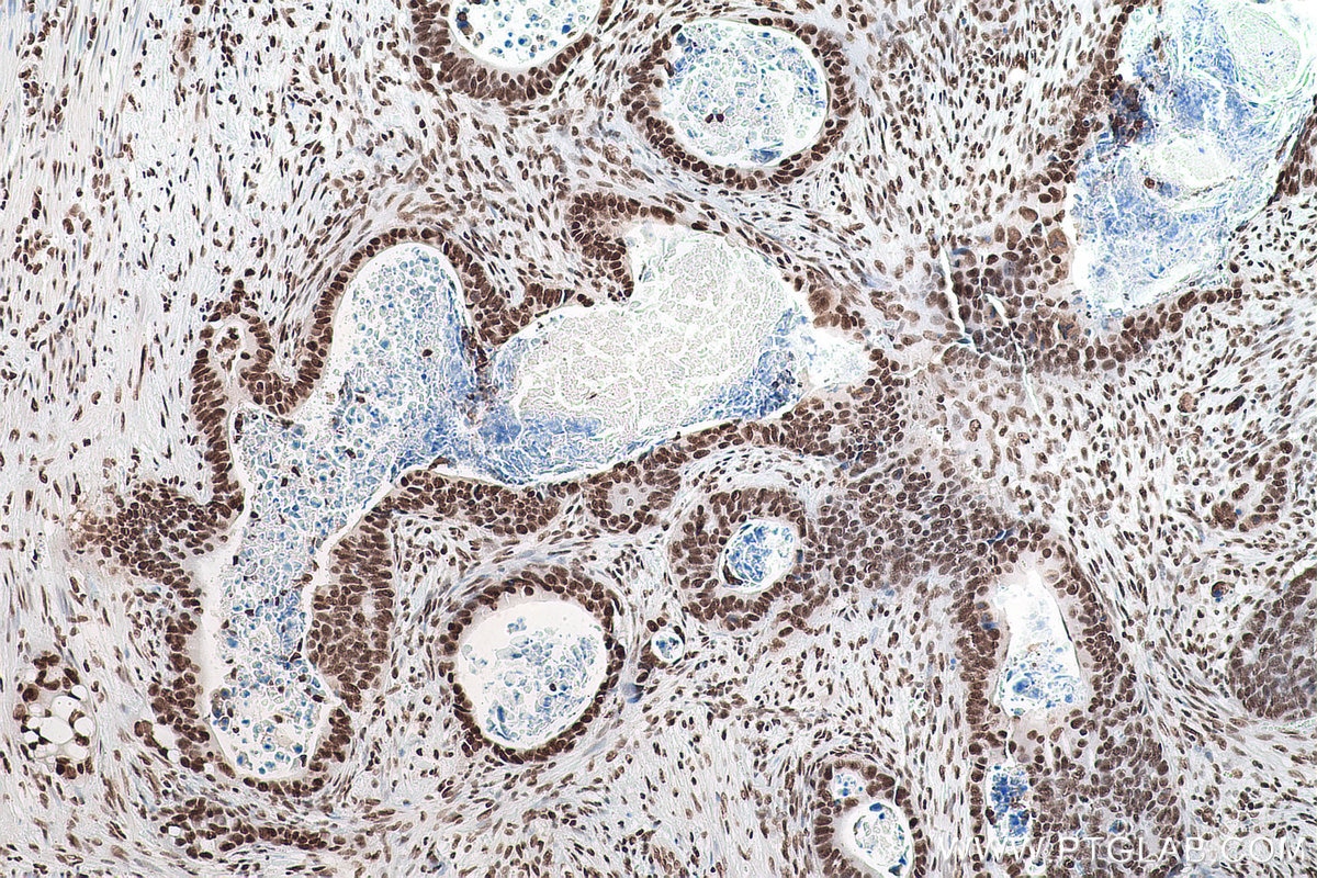 Immunohistochemical analysis of paraffin-embedded human colon cancer tissue slide using KHC0870 (NUDT21 IHC Kit).