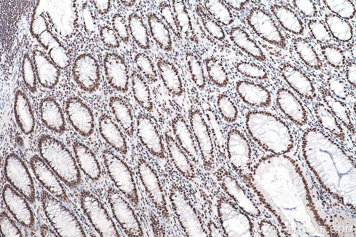 Immunohistochemical analysis of paraffin-embedded human colon cancer tissue(ANCT) slide using KHC0870 (NUDT21 IHC Kit).
