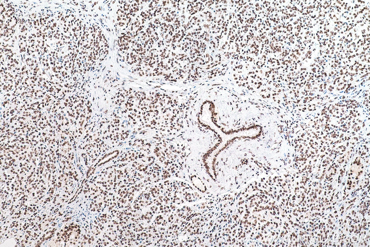 Immunohistochemical analysis of paraffin-embedded human pancreas cancer tissue slide using KHC0870 (NUDT21 IHC Kit).