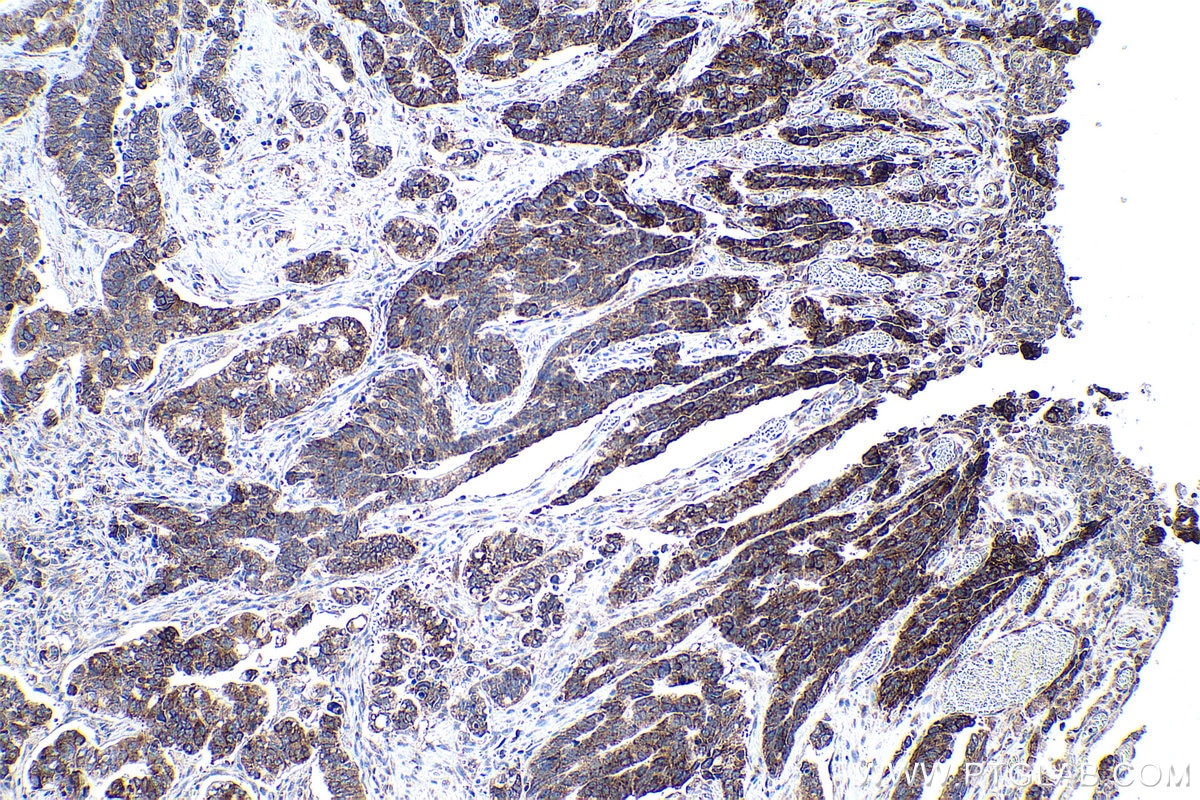 Immunohistochemical analysis of paraffin-embedded human stomach cancer tissue slide using KHC0958 (NUFIP2 IHC Kit).