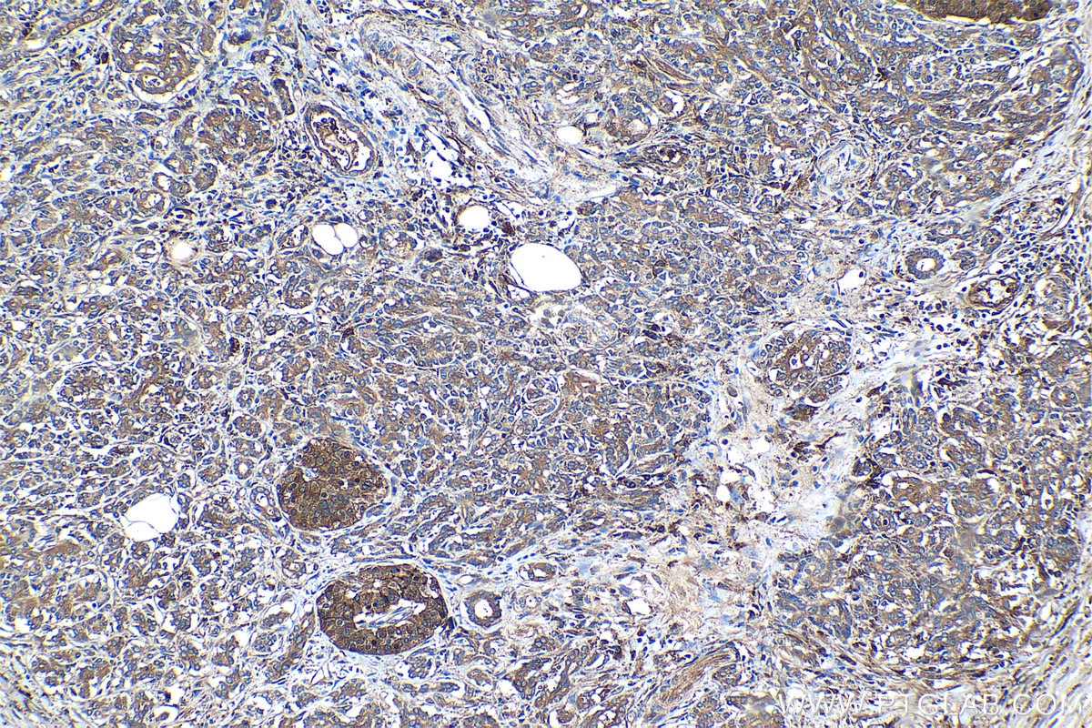 Immunohistochemical analysis of paraffin-embedded human pancreas cancer tissue slide using KHC1269 (NUMBL IHC Kit).