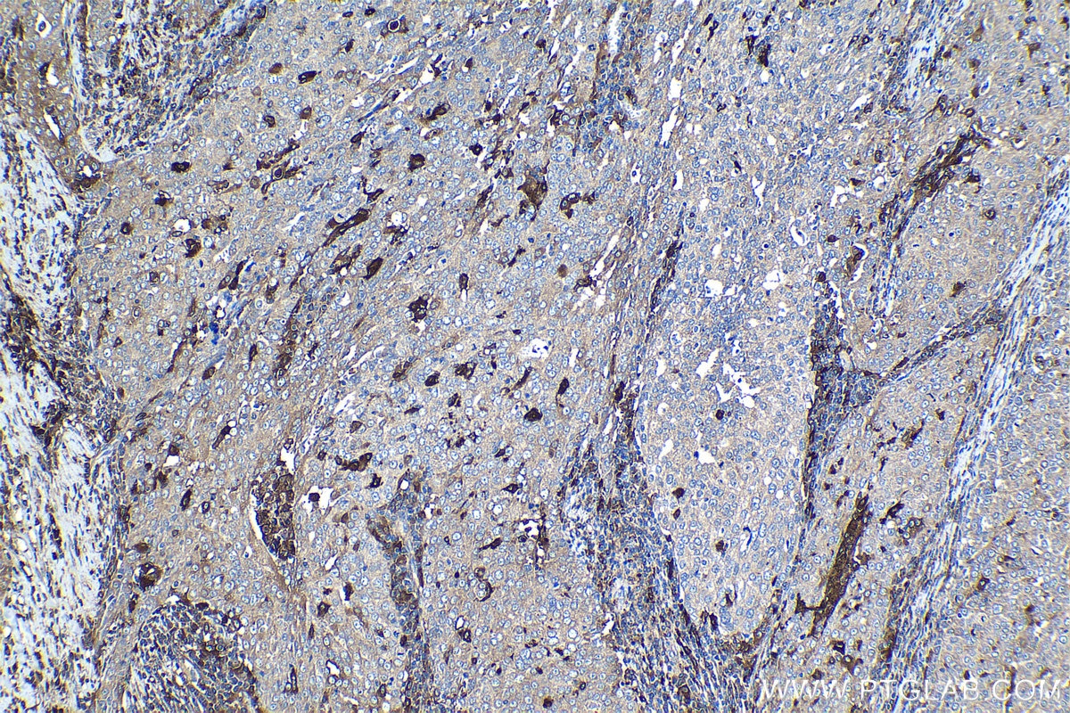 Immunohistochemical analysis of paraffin-embedded human ovary tumor tissue slide using KHC1269 (NUMBL IHC Kit).