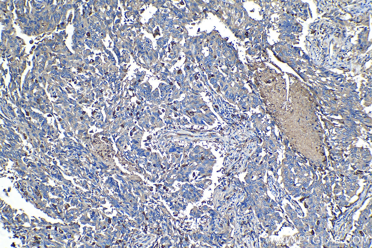 Immunohistochemical analysis of paraffin-embedded human lung cancer tissue slide using KHC1269 (NUMBL IHC Kit).