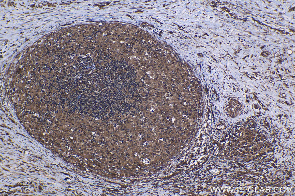 Immunohistochemical analysis of paraffin-embedded human lymphoma tissue slide using KHC1200 (NUP214 IHC Kit).