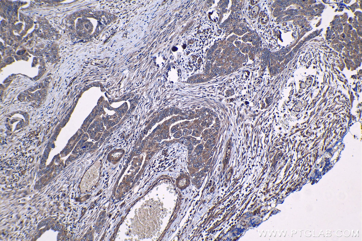 Immunohistochemical analysis of paraffin-embedded human ovary tumor tissue slide using KHC1200 (NUP214 IHC Kit).