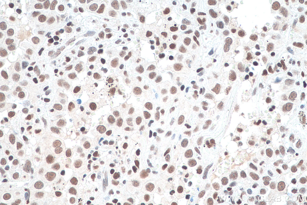 Immunohistochemical analysis of paraffin-embedded human lung cancer tissue slide using KHC0934 (NUP50 IHC Kit).