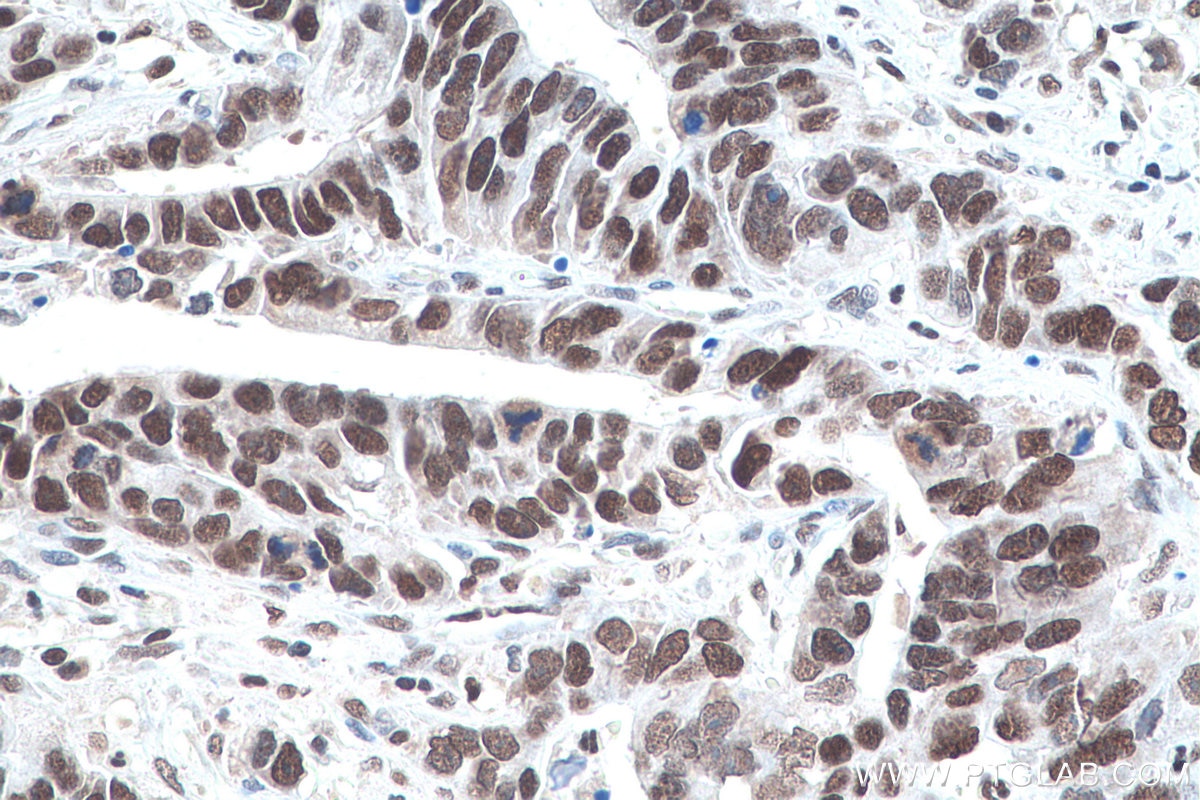 Immunohistochemical analysis of paraffin-embedded human stomach cancer tissue slide using KHC0934 (NUP50 IHC Kit).