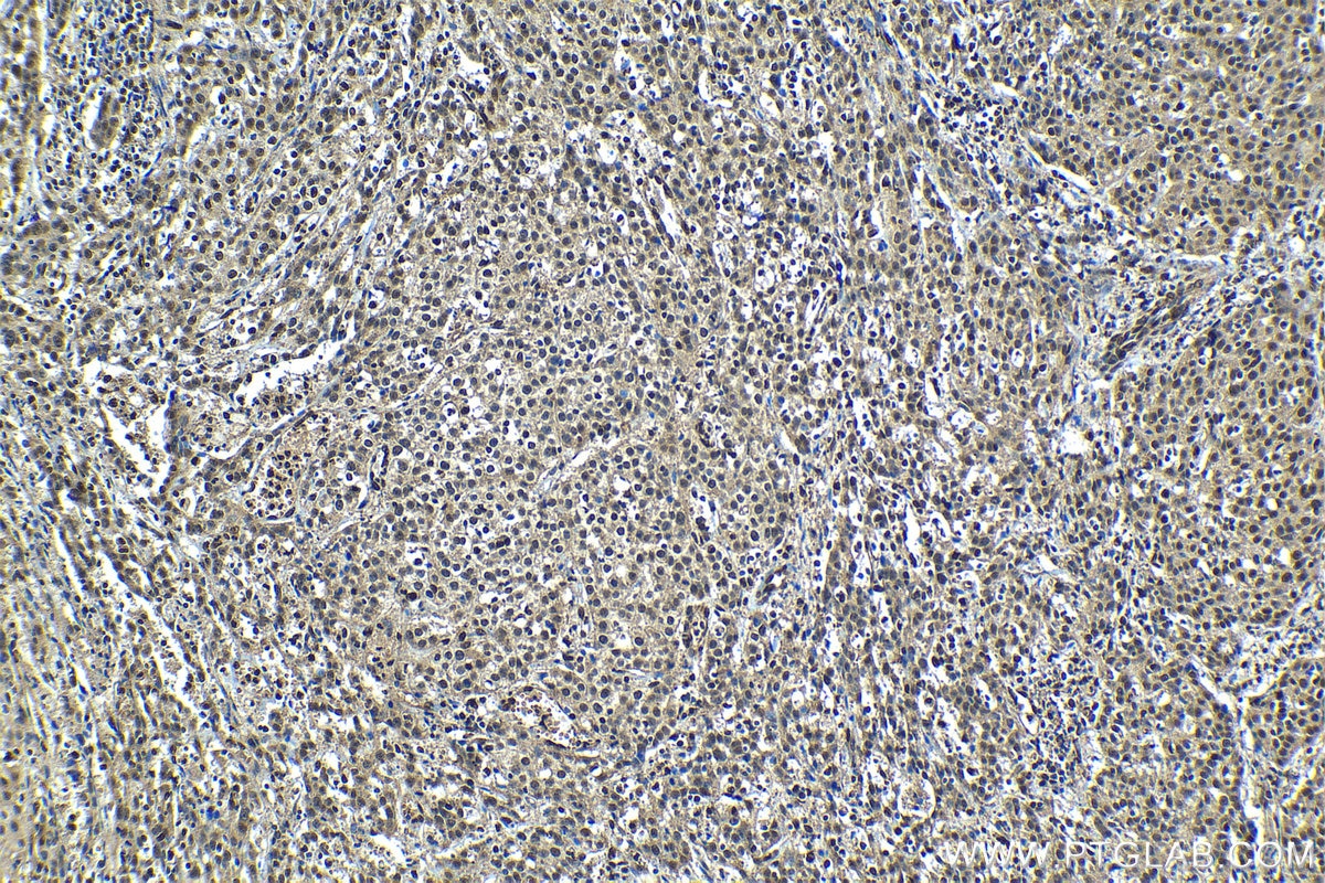 Immunohistochemical analysis of paraffin-embedded human cervical cancer tissue slide using KHC1201 (NUP62CL IHC Kit).