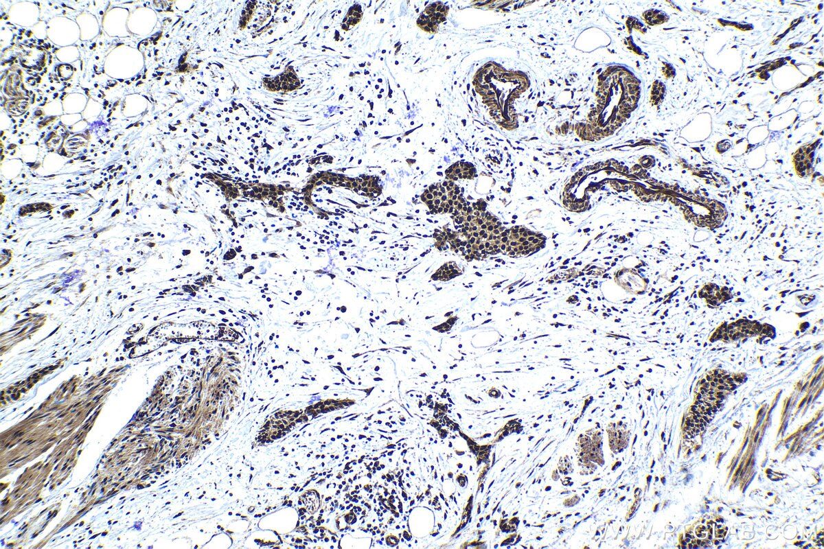 Immunohistochemical analysis of paraffin-embedded human urothelial carcinoma tissue slide using KHC1201 (NUP62CL IHC Kit).