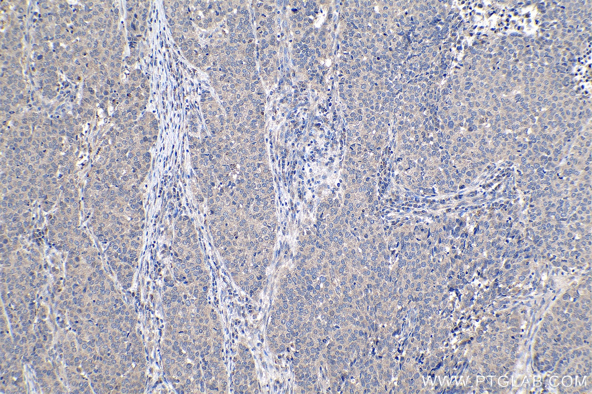 Immunohistochemical analysis of paraffin-embedded human stomach cancer tissue slide using KHC1202 (NUP85 IHC Kit).