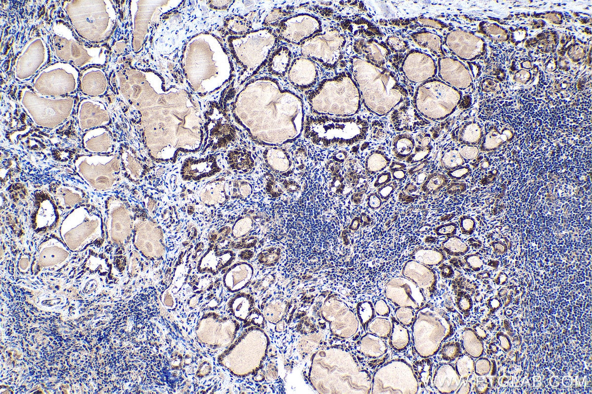 Immunohistochemical analysis of paraffin-embedded human thyroid cancer tissue slide using KHC1466 (NUPR1 IHC Kit).