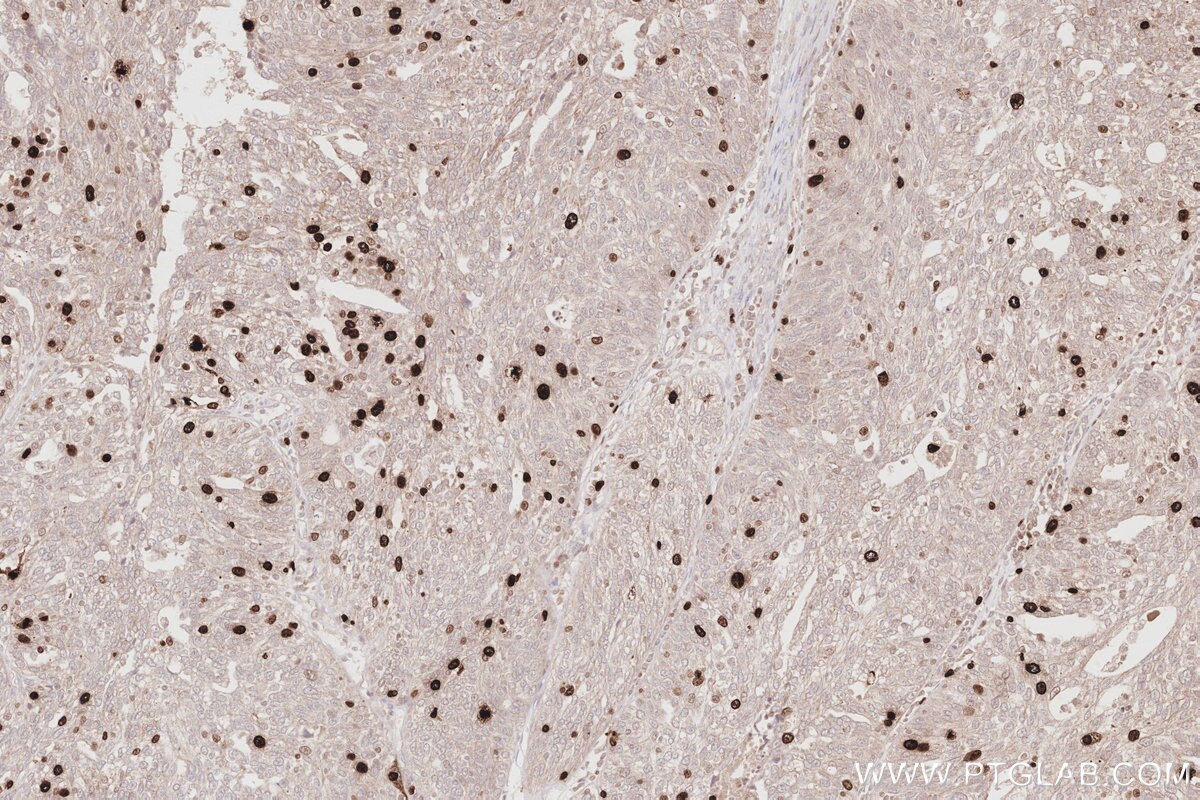 Immunohistochemical analysis of paraffin-embedded human ovary cancer tissue slide using KHC2883 (NUSAP1 IHC Kit).