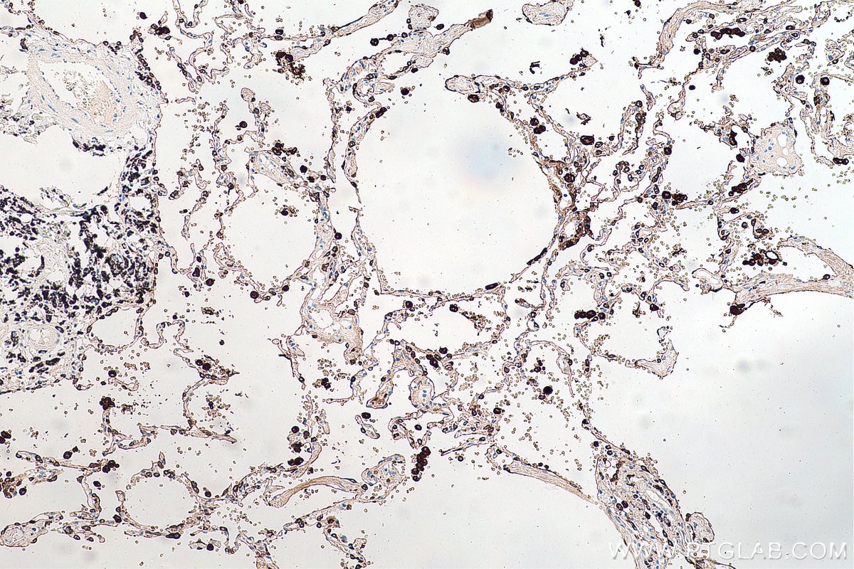 Immunohistochemical analysis of paraffin-embedded human lung cancer tissue slide using KHC0068 (Napsin A IHC Kit).