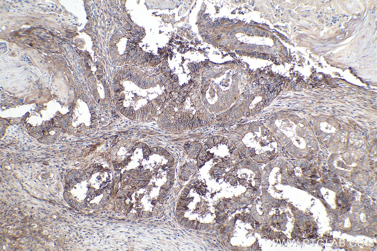 Immunohistochemical analysis of paraffin-embedded human ovary tumor tissue slide using KHC0114 (Nectin-2/PVRL2 IHC Kit).