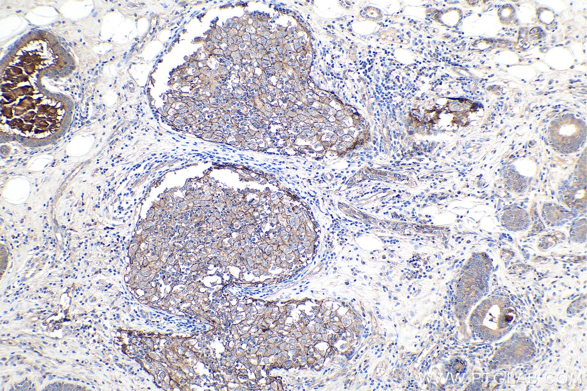 Immunohistochemical analysis of paraffin-embedded human breast cancer tissue slide using KHC0114 (Nectin-2/PVRL2 IHC Kit).