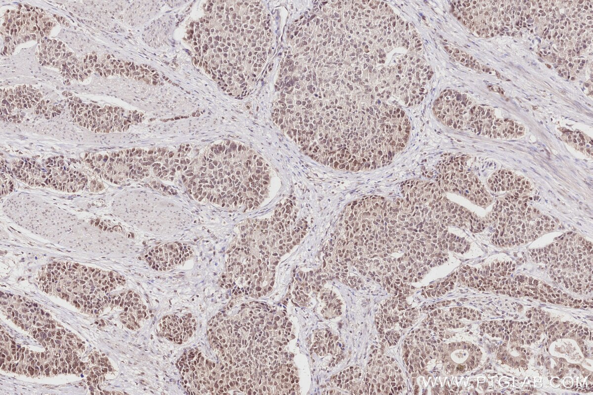 Immunohistochemical analysis of paraffin-embedded human stomach cancer tissue slide using KHC2853 (OBFC2B IHC Kit).