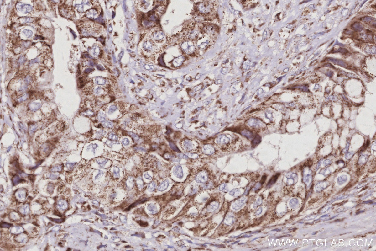 Immunohistochemical analysis of paraffin-embedded human pancreas cancer tissue slide using KHC3034 (OGDHL IHC Kit). Immunohistochemical analysis of paraffin-embedded human pancreas cancer tissue slide using KHC3034 (OGDHL IHC Kit).