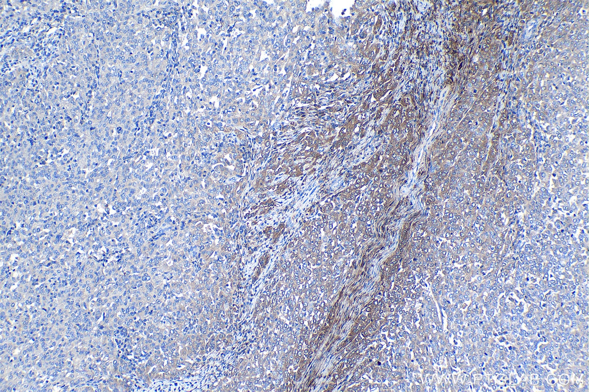 Immunohistochemical analysis of paraffin-embedded human ovary tumor tissue slide using KHC1277 (OGN IHC Kit).