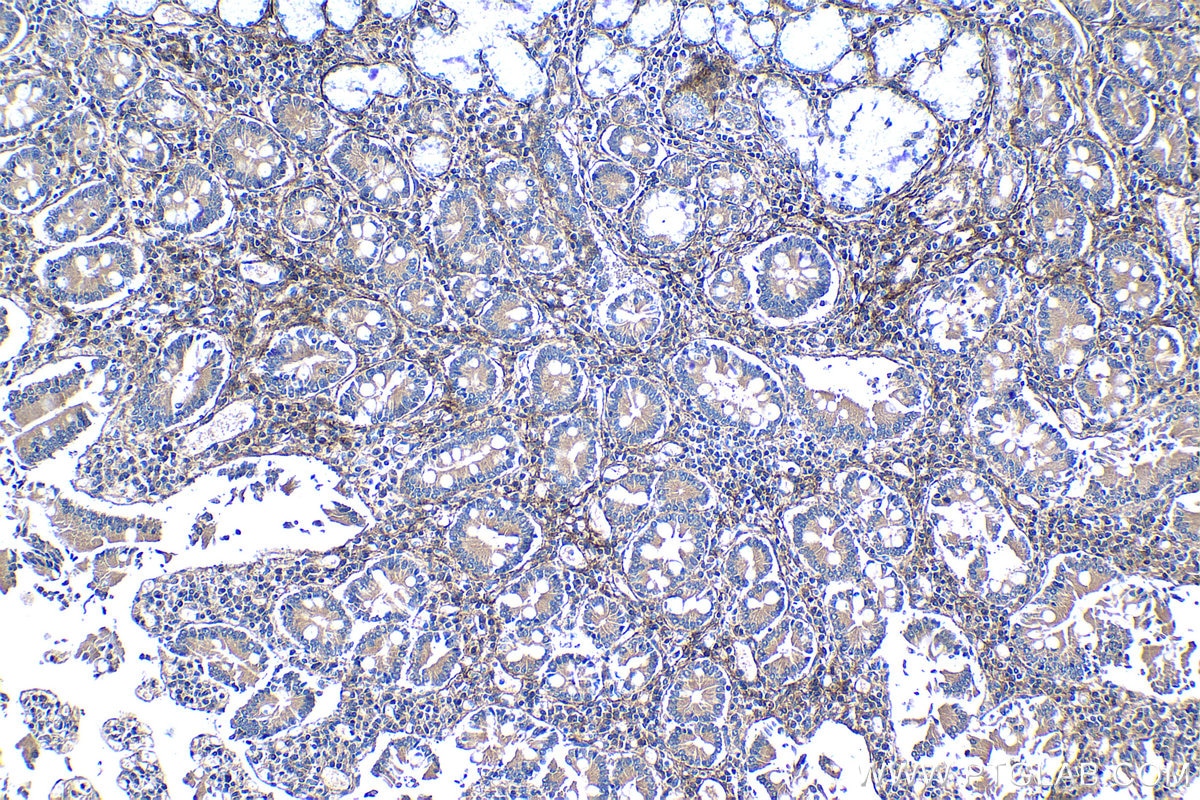 Immunohistochemical analysis of paraffin-embedded human stomach cancer tissue slide using KHC1277 (OGN IHC Kit).
