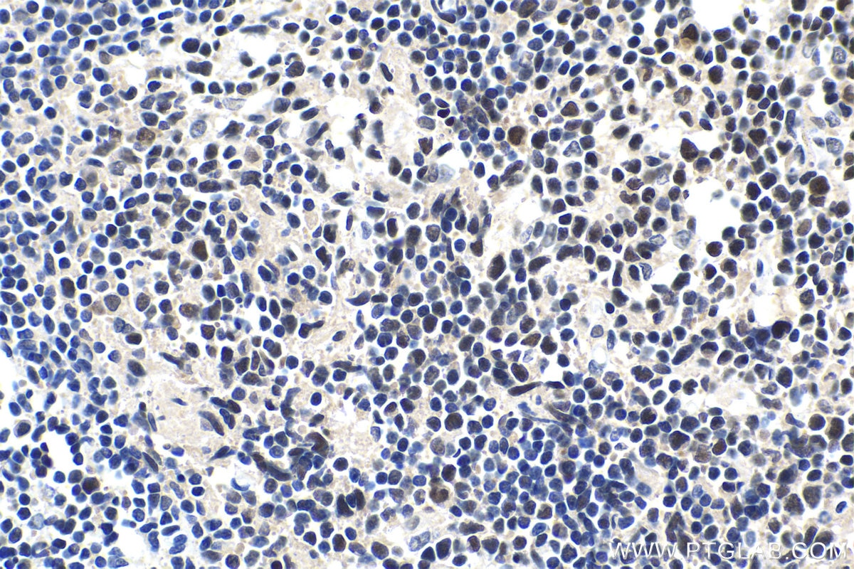 Immunohistochemical analysis of paraffin-embedded human thyroid cancer tissue slide using KHC1442 (OGT IHC Kit).