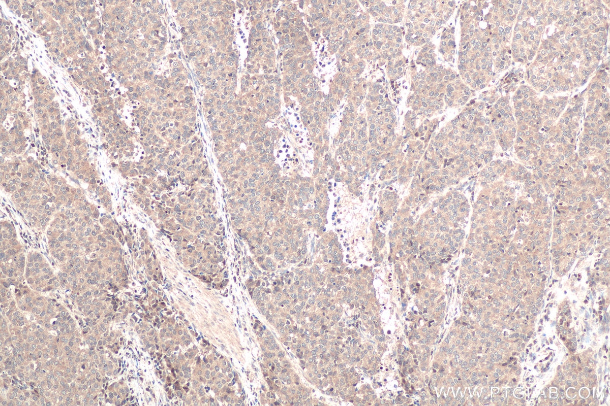 Immunohistochemical analysis of paraffin-embedded human stomach cancer tissue slide using KHC0716 (ORM2 IHC Kit).