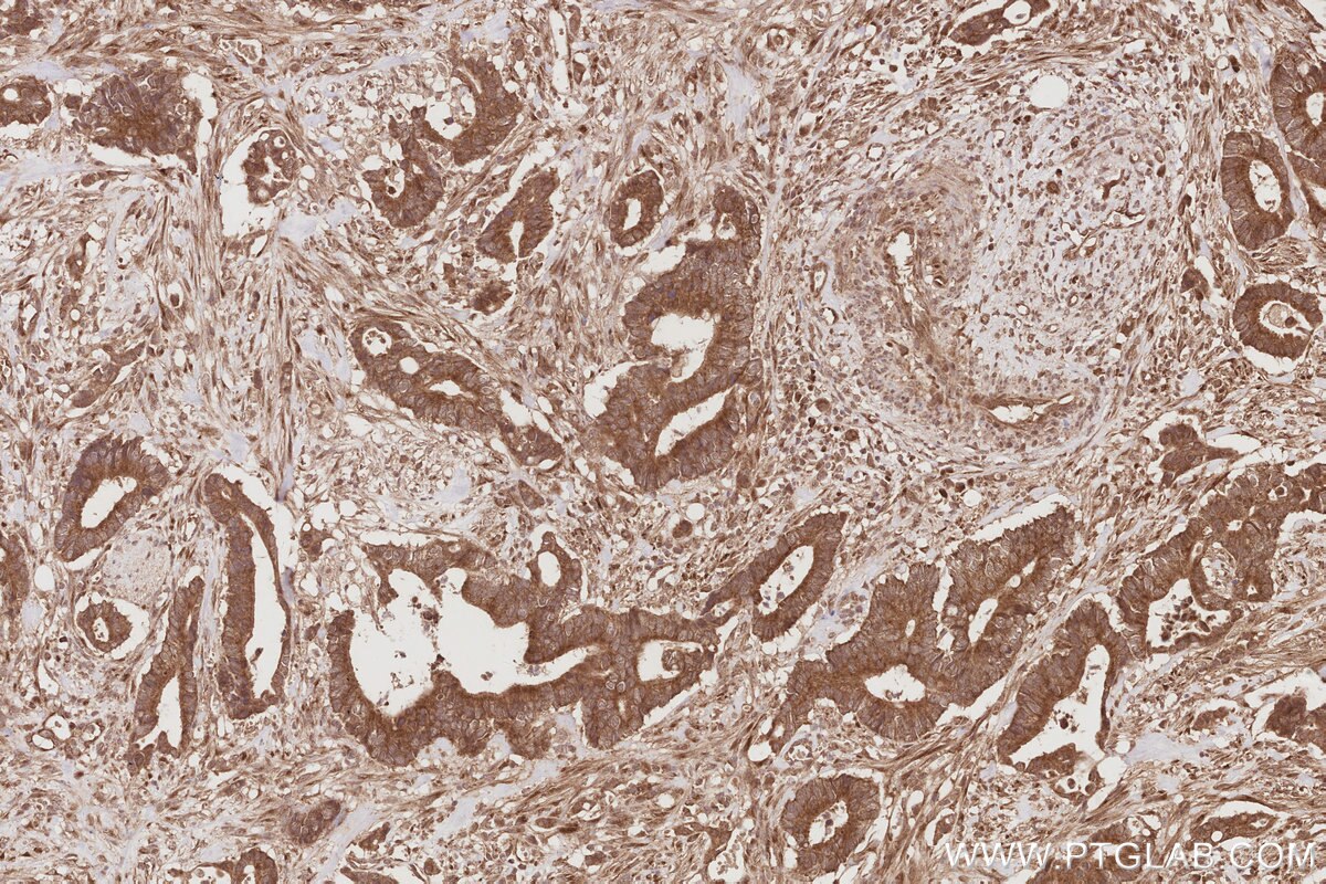 Immunohistochemical analysis of paraffin-embedded human rectal cancer tissue slide using KHC2881 (OSBPL10 IHC Kit).