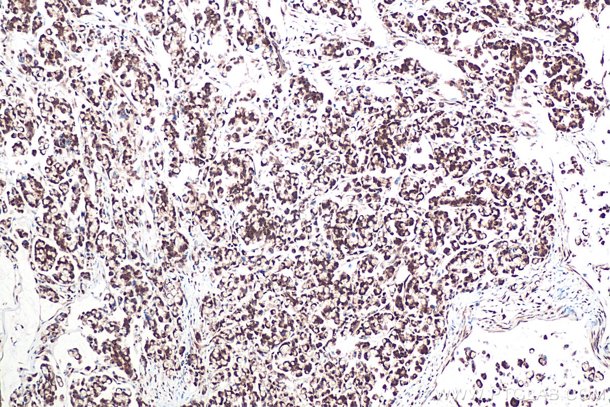 Immunohistochemical analysis of paraffin-embedded human colon cancer tissue slide using KHC0951 (OSGEP IHC Kit).
