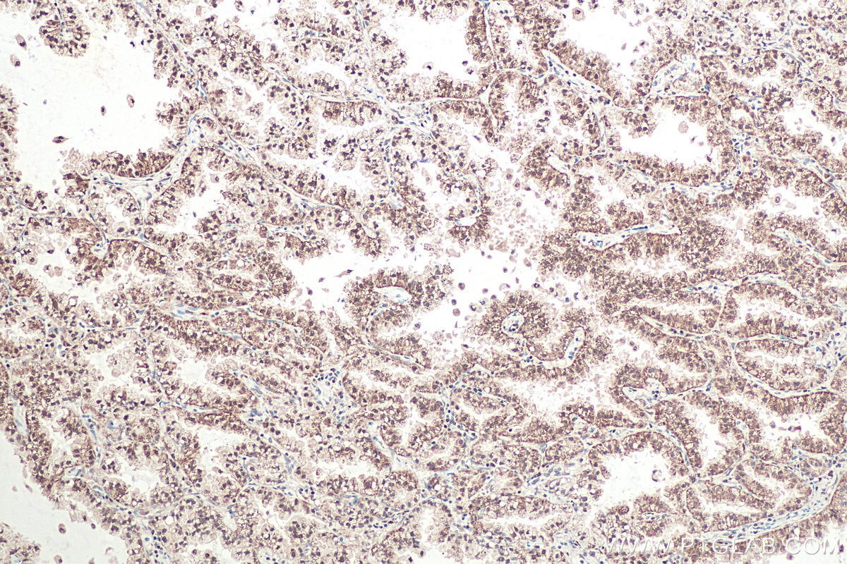 Immunohistochemical analysis of paraffin-embedded human lung cancer tissue slide using KHC0951 (OSGEP IHC Kit).