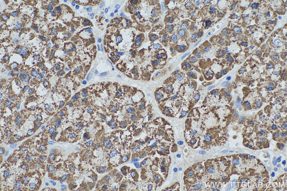 Immunohistochemical analysis of paraffin-embedded human liver cancer tissue slide using KHC0493 (OTC IHC Kit).
