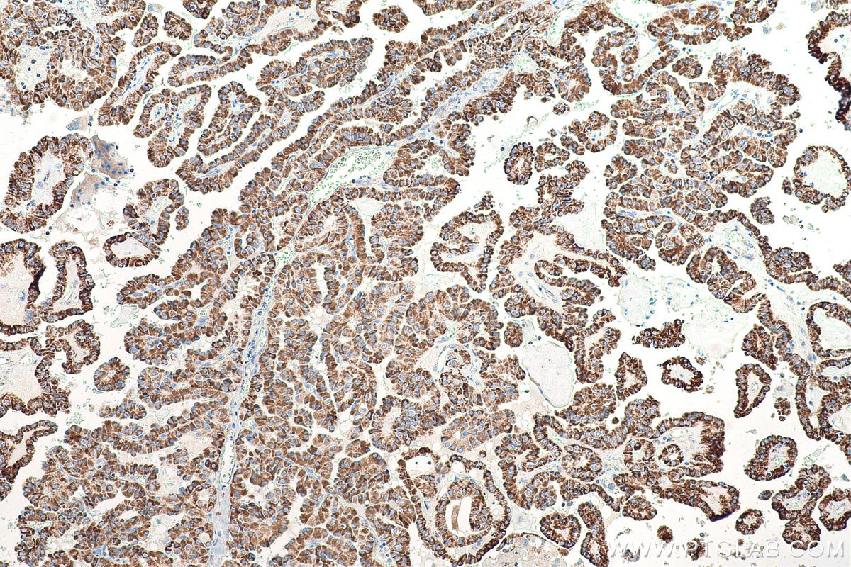 Immunohistochemical analysis of paraffin-embedded human thyroid cancer tissue slide using KHC0888 (OXCT1 IHC Kit).