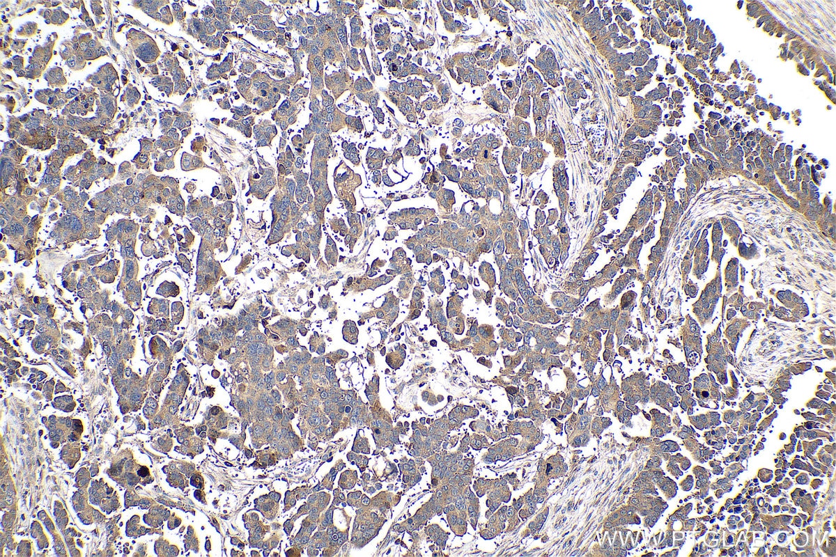 Immunohistochemical analysis of paraffin-embedded human colon cancer tissue slide using KHC0782 (Osteopontin/SPP1 IHC Kit).