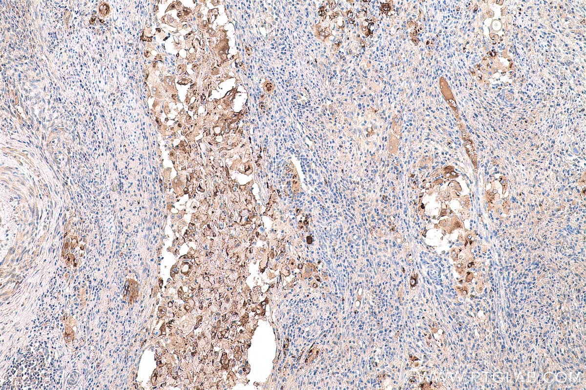Immunohistochemical analysis of paraffin-embedded human cervical cancer tissue slide using KHC0782 (Osteopontin/SPP1 IHC Kit).