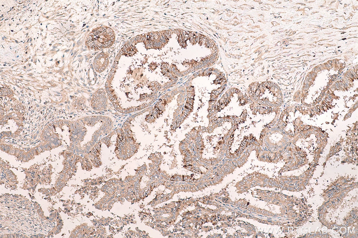 Immunohistochemical analysis of paraffin-embedded human ovary tumor tissue slide using KHC0782 (Osteopontin/SPP1 IHC Kit).