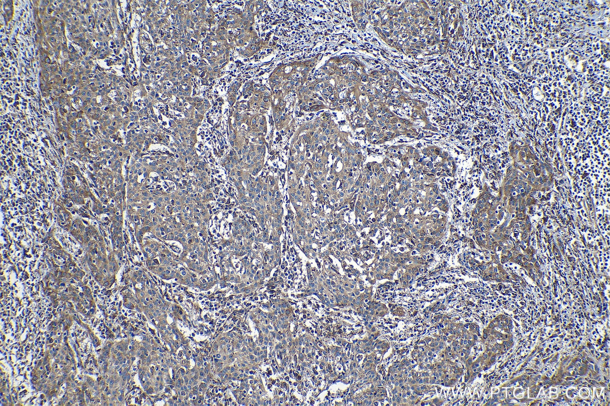 Immunohistochemical analysis of paraffin-embedded human cervical cancer tissue slide using KHC1229 (P4HA1 IHC Kit).
