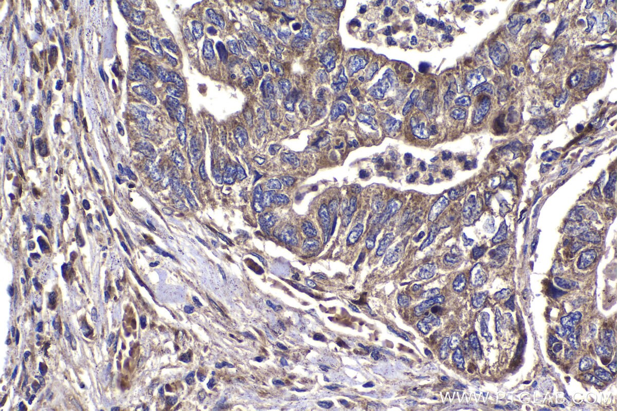 Immunohistochemical analysis of paraffin-embedded human stomach cancer tissue slide using KHC1369 (P4HA2 IHC Kit).