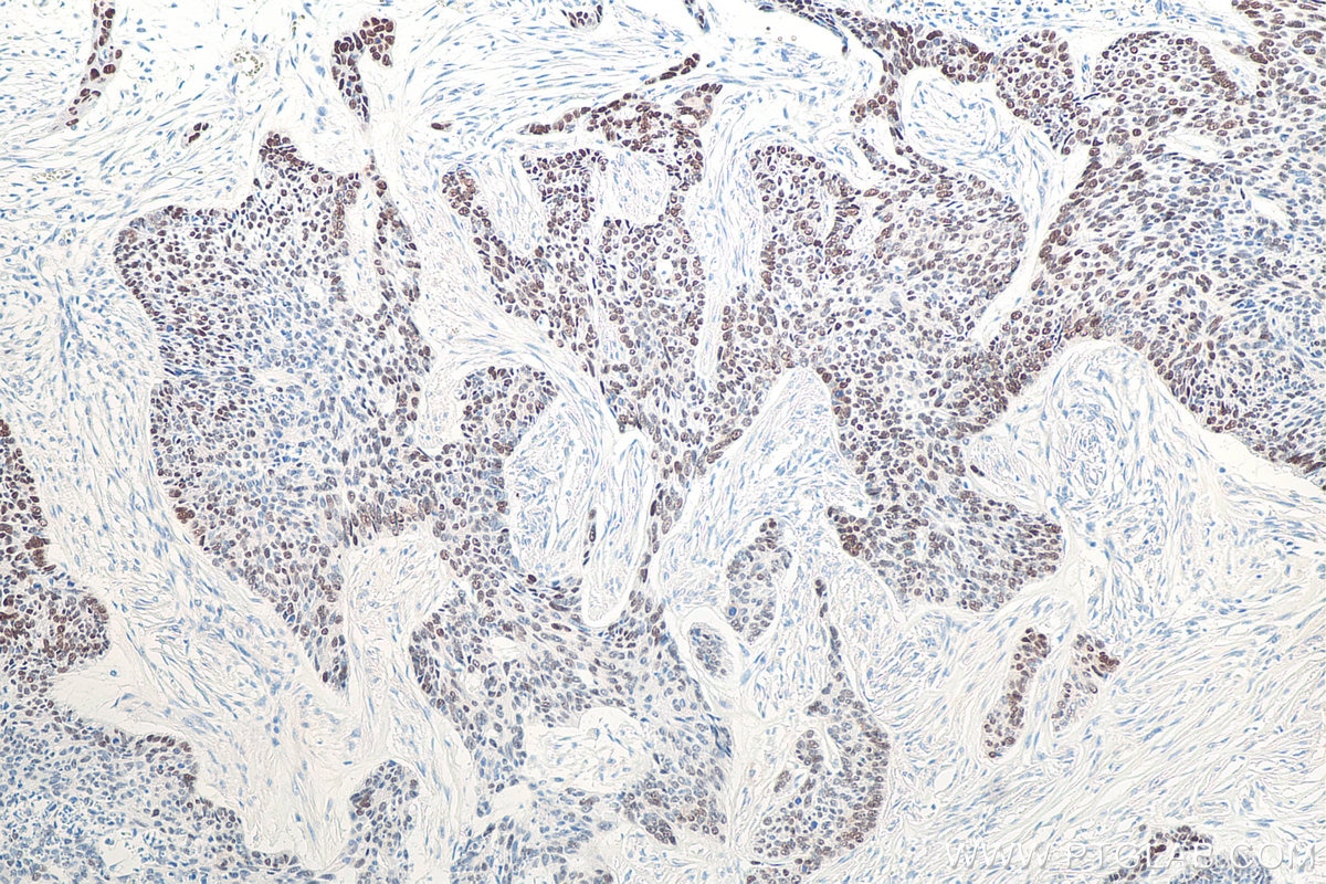 Immunohistochemical analysis of paraffin-embedded human skin cancer tissue slide using KHC0079 (P53 IHC Kit).