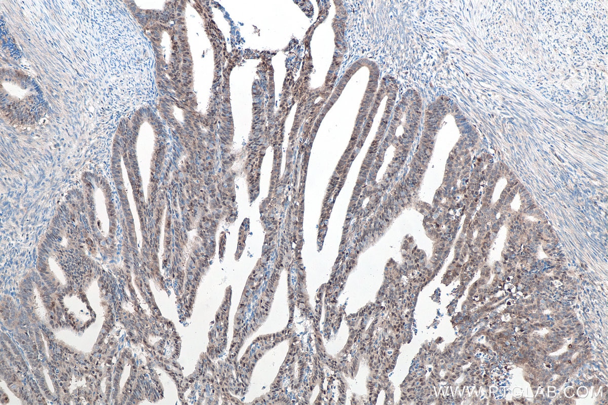 Immunohistochemical analysis of paraffin-embedded human endometrial cancer tissue slide using KHC0058 (P62,SQSTM1 IHC Kit).
