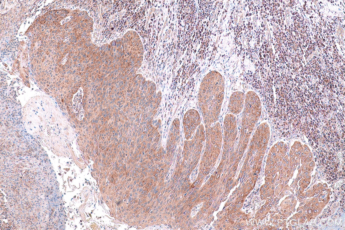 Immunohistochemical analysis of paraffin-embedded human oesophagus cancer tissue slide using KHC0853 (PA2G4 IHC Kit).