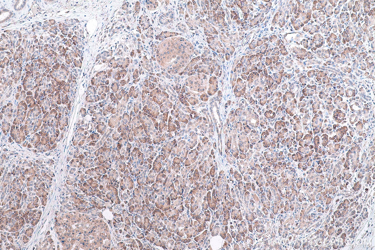 Immunohistochemical analysis of paraffin-embedded human pancreas cancer tissue slide using KHC0853 (PA2G4 IHC Kit).